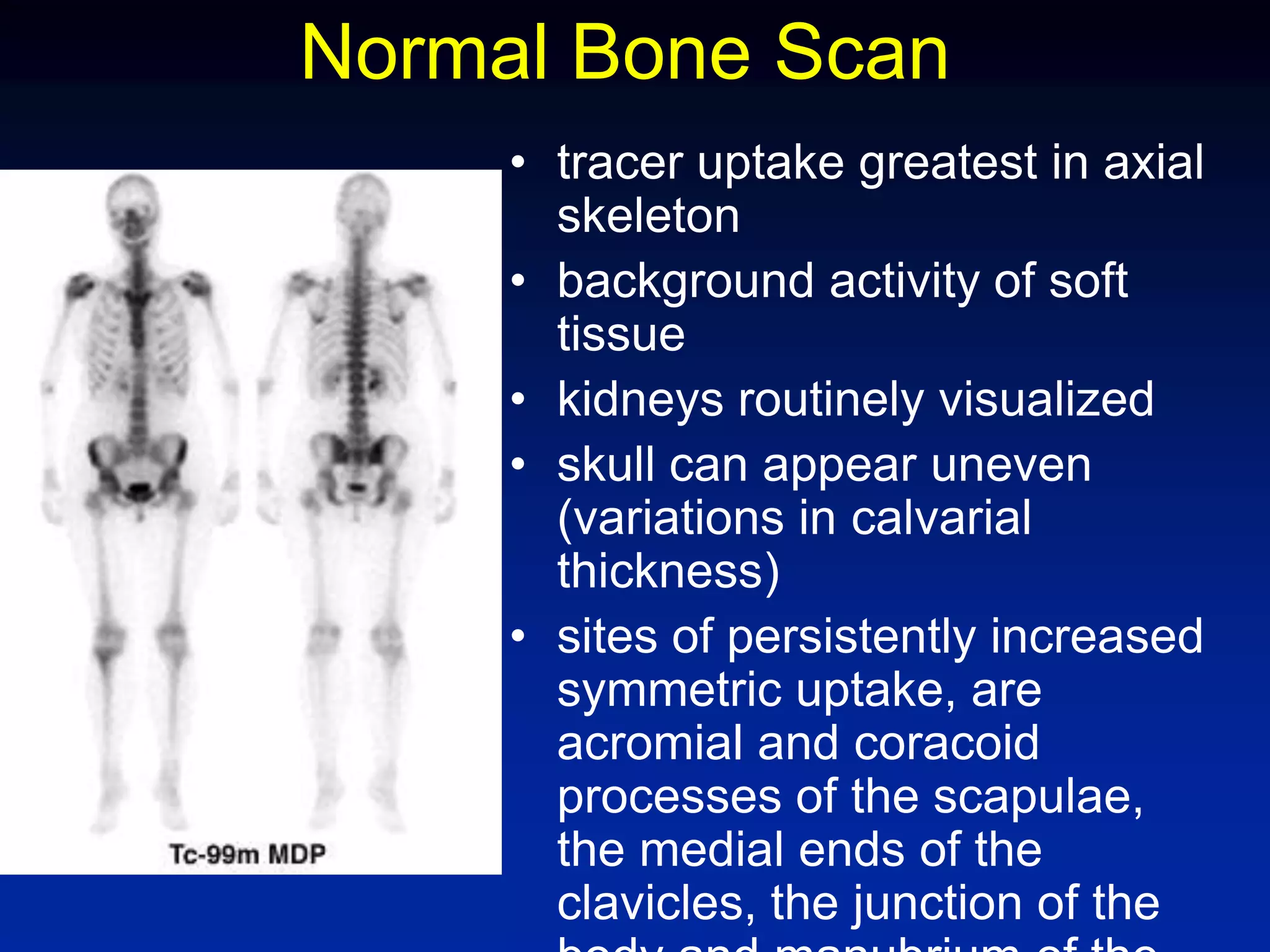 Normal Bone Scan
• tracer uptake greatest in axial
skeleton
• background activity of soft
tissue
• kidneys routinely visualized
• skull can appear uneven
(variations in calvarial
thickness)
• sites of persistently increased
symmetric uptake, are
acromial and coracoid
processes of the scapulae,
the medial ends of the
clavicles, the junction of the
 