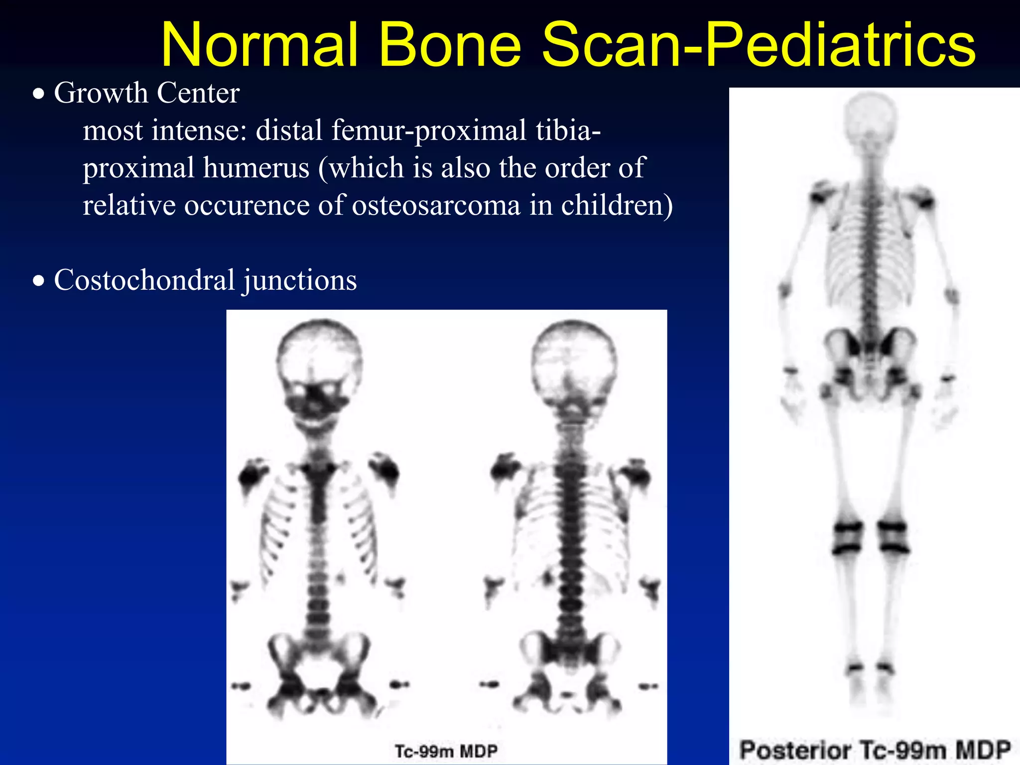 Normal Bone Scan-Pediatrics
Growth Center
most intense: distal femur-proximal tibia-
proximal humerus (which is also the order of
relative occurence of osteosarcoma in children)
Costochondral junctions
 