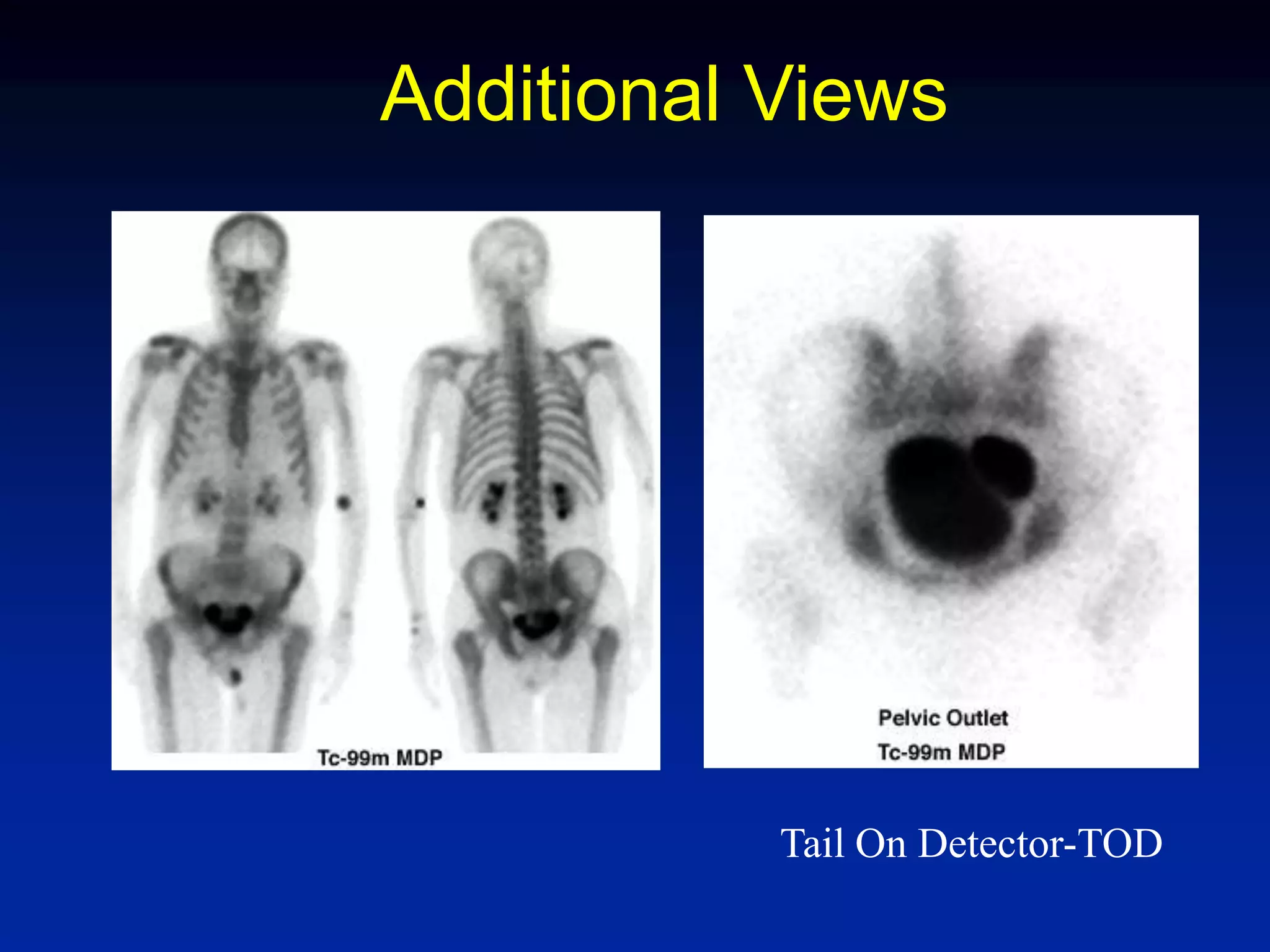 Additional Views
Tail On Detector-TOD
 
