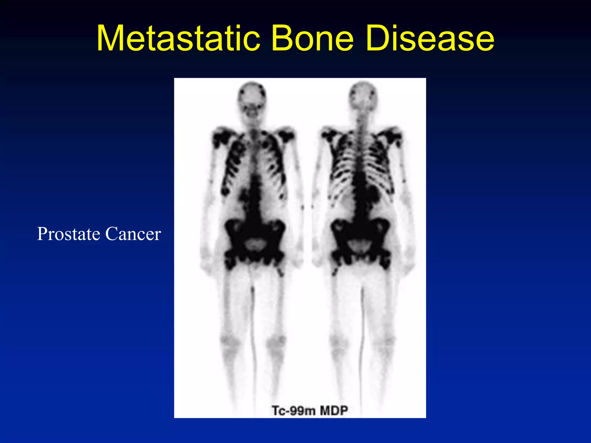 Metastatic Bone Disease
Prostate Cancer
 
