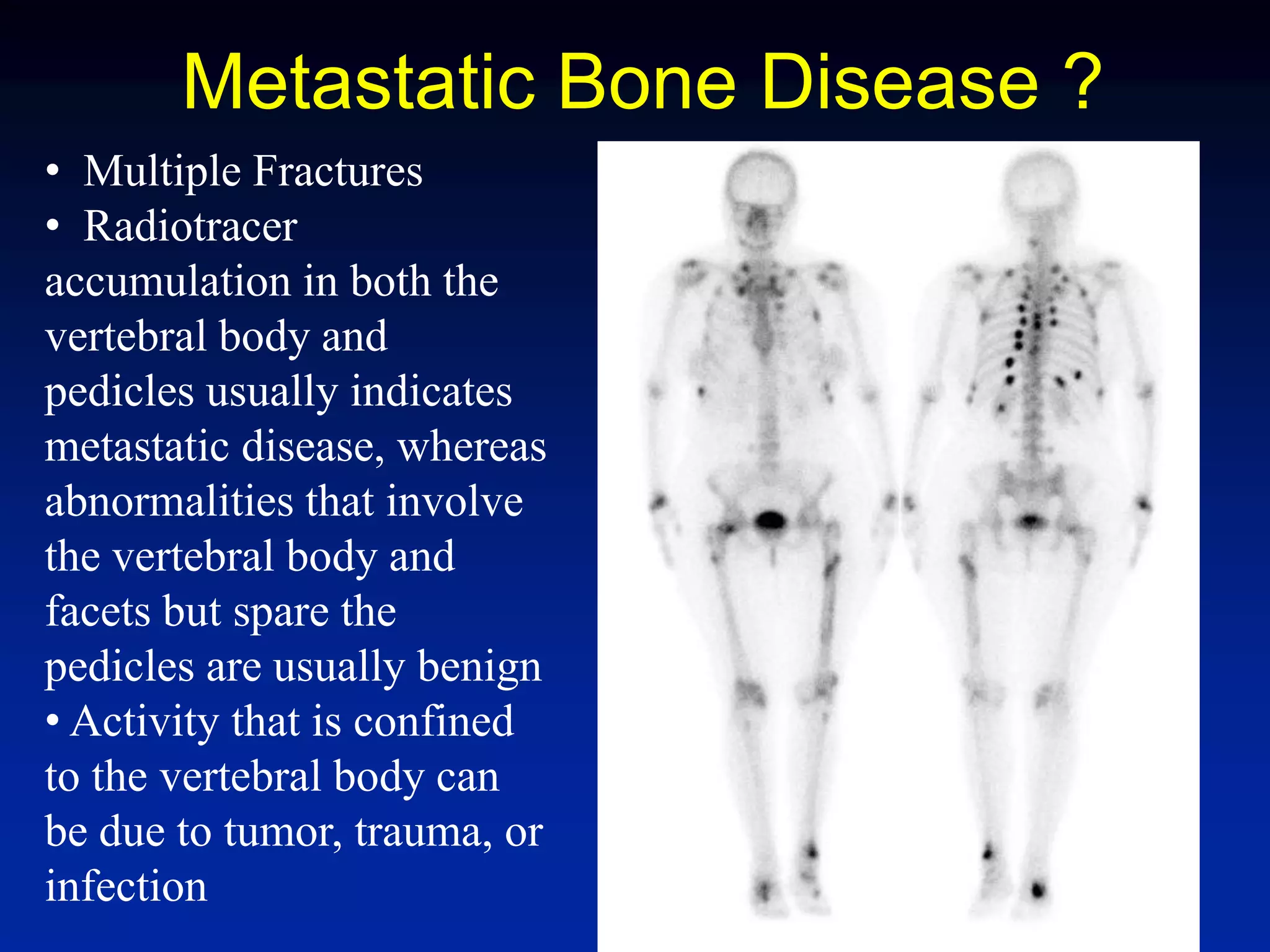 Metastatic Bone Disease ?
• Multiple Fractures
• Radiotracer
accumulation in both the
vertebral body and
pedicles usually indicates
metastatic disease, whereas
abnormalities that involve
the vertebral body and
facets but spare the
pedicles are usually benign
• Activity that is confined
to the vertebral body can
be due to tumor, trauma, or
infection
 