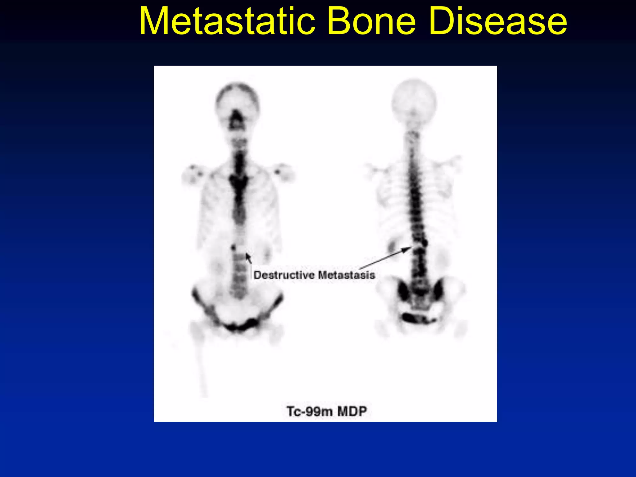 Metastatic Bone Disease
 