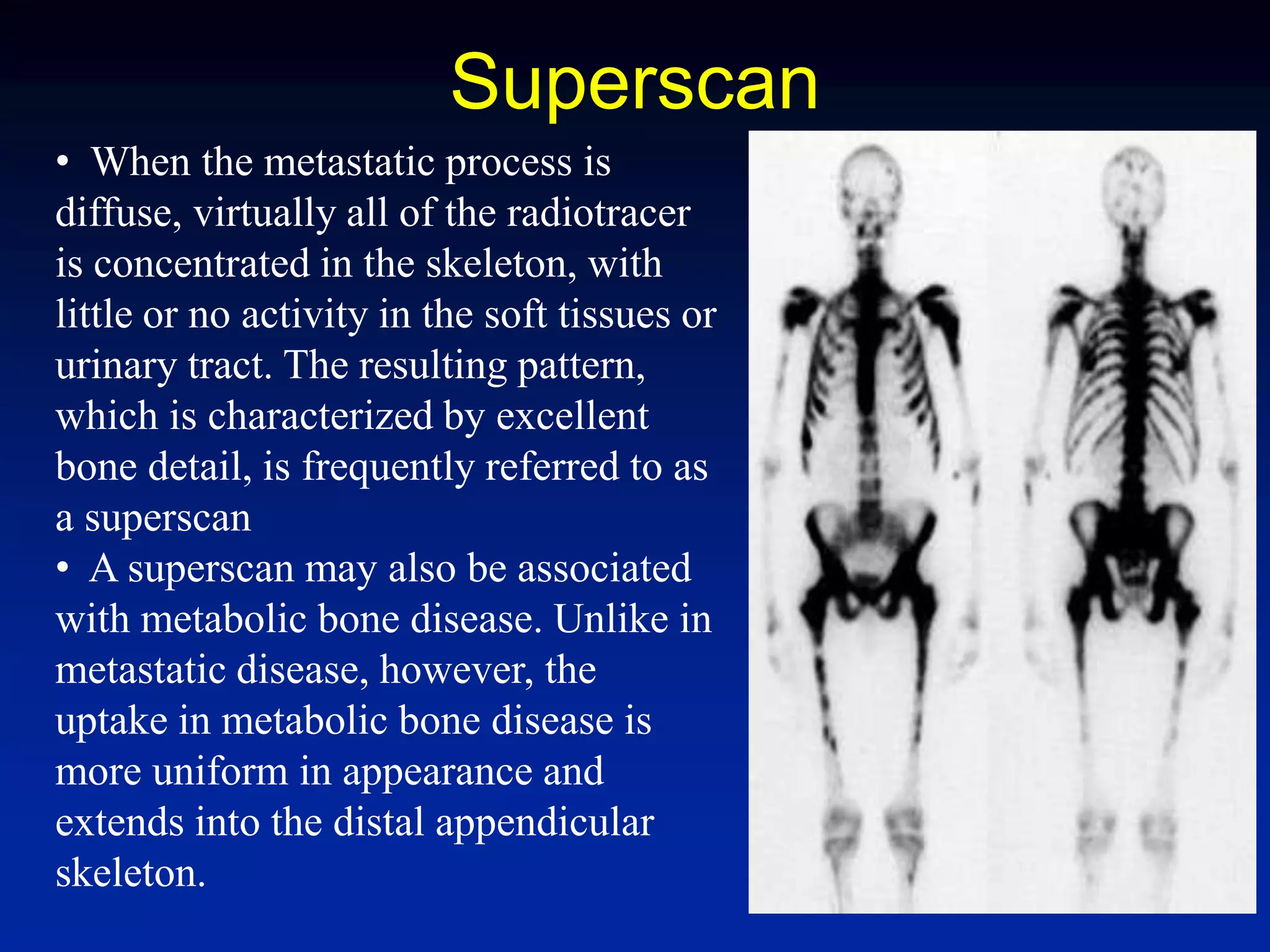 Superscan
• When the metastatic process is
diffuse, virtually all of the radiotracer
is concentrated in the skeleton, with
little or no activity in the soft tissues or
urinary tract. The resulting pattern,
which is characterized by excellent
bone detail, is frequently referred to as
a superscan
• A superscan may also be associated
with metabolic bone disease. Unlike in
metastatic disease, however, the
uptake in metabolic bone disease is
more uniform in appearance and
extends into the distal appendicular
skeleton.
 