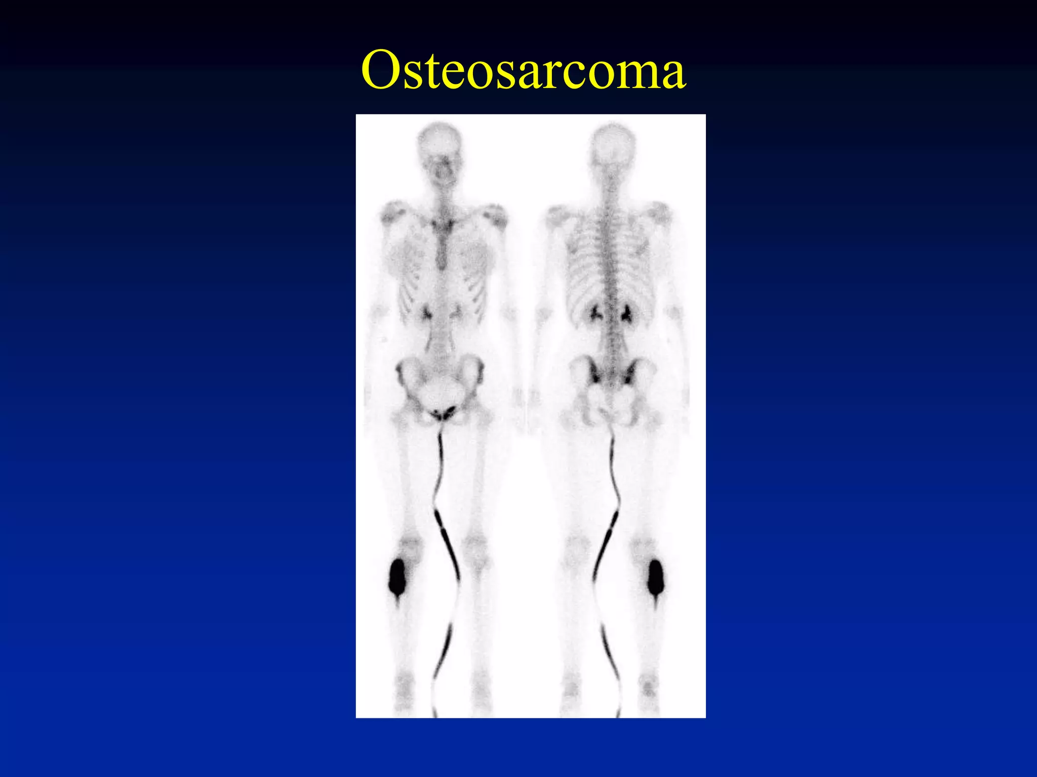 Osteosarcoma
 