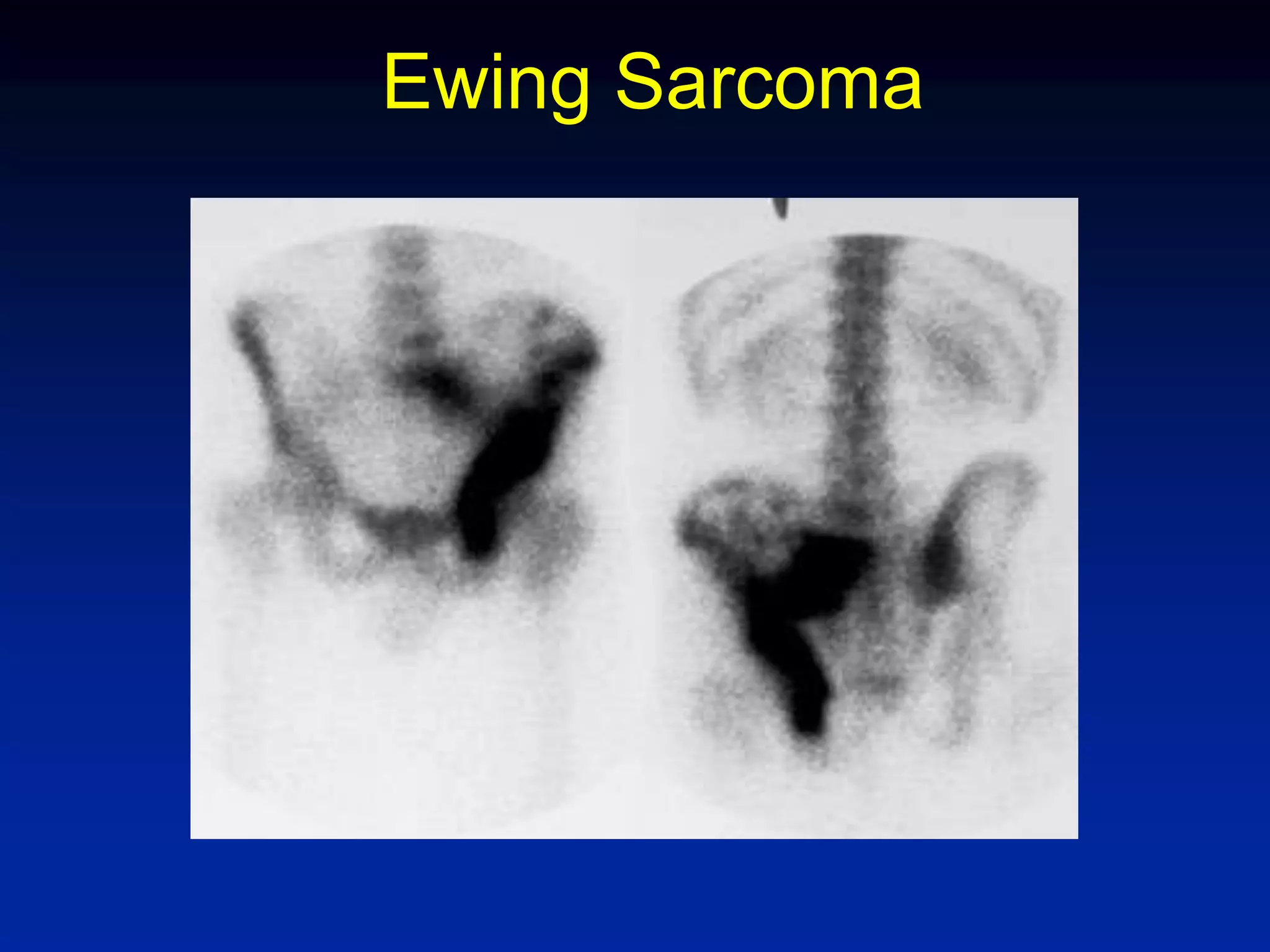 Ewing Sarcoma
 