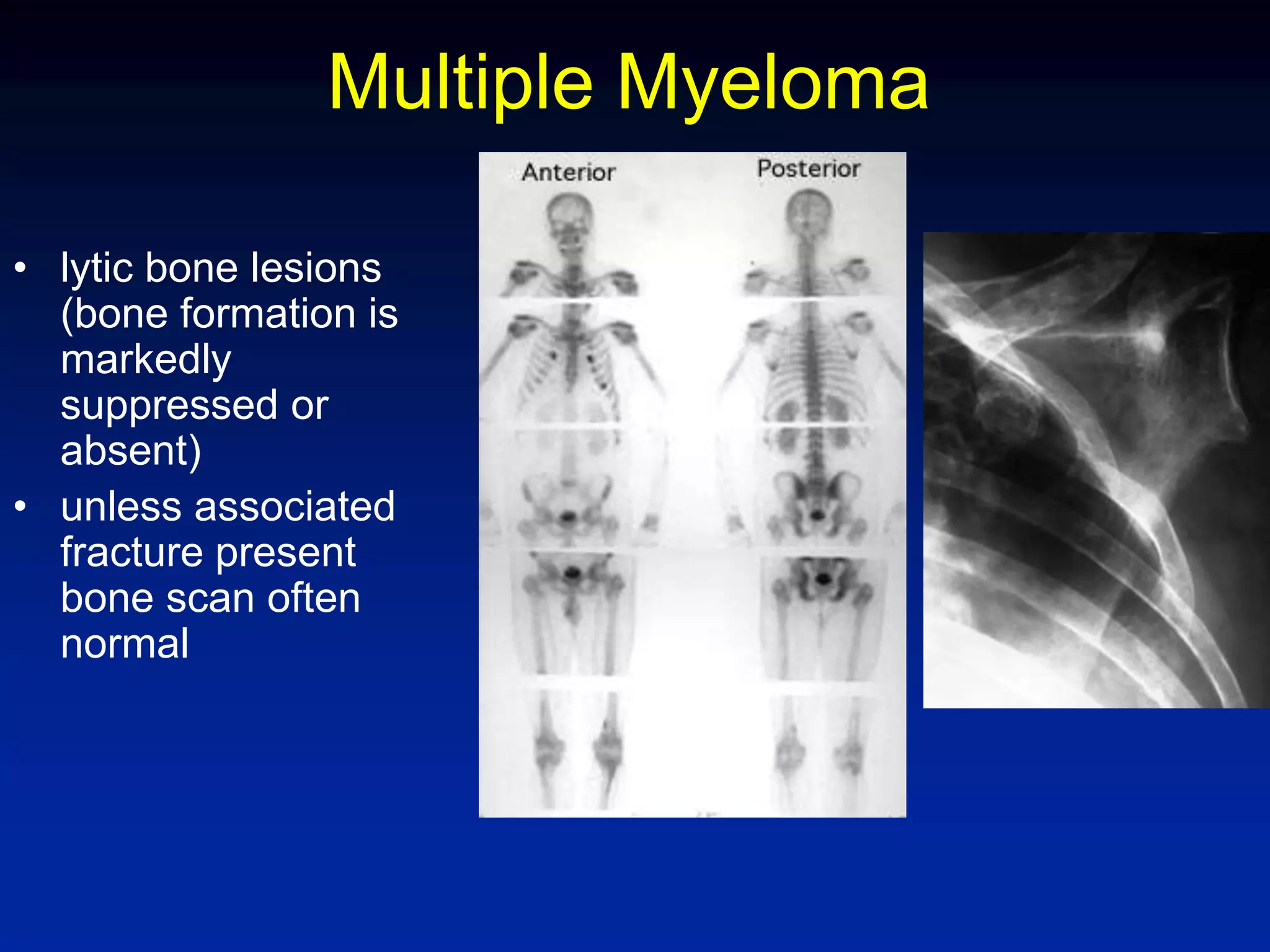 Multiple Myeloma
• lytic bone lesions
(bone formation is
markedly
suppressed or
absent)
• unless associated
fracture present
bone scan often
normal
 
