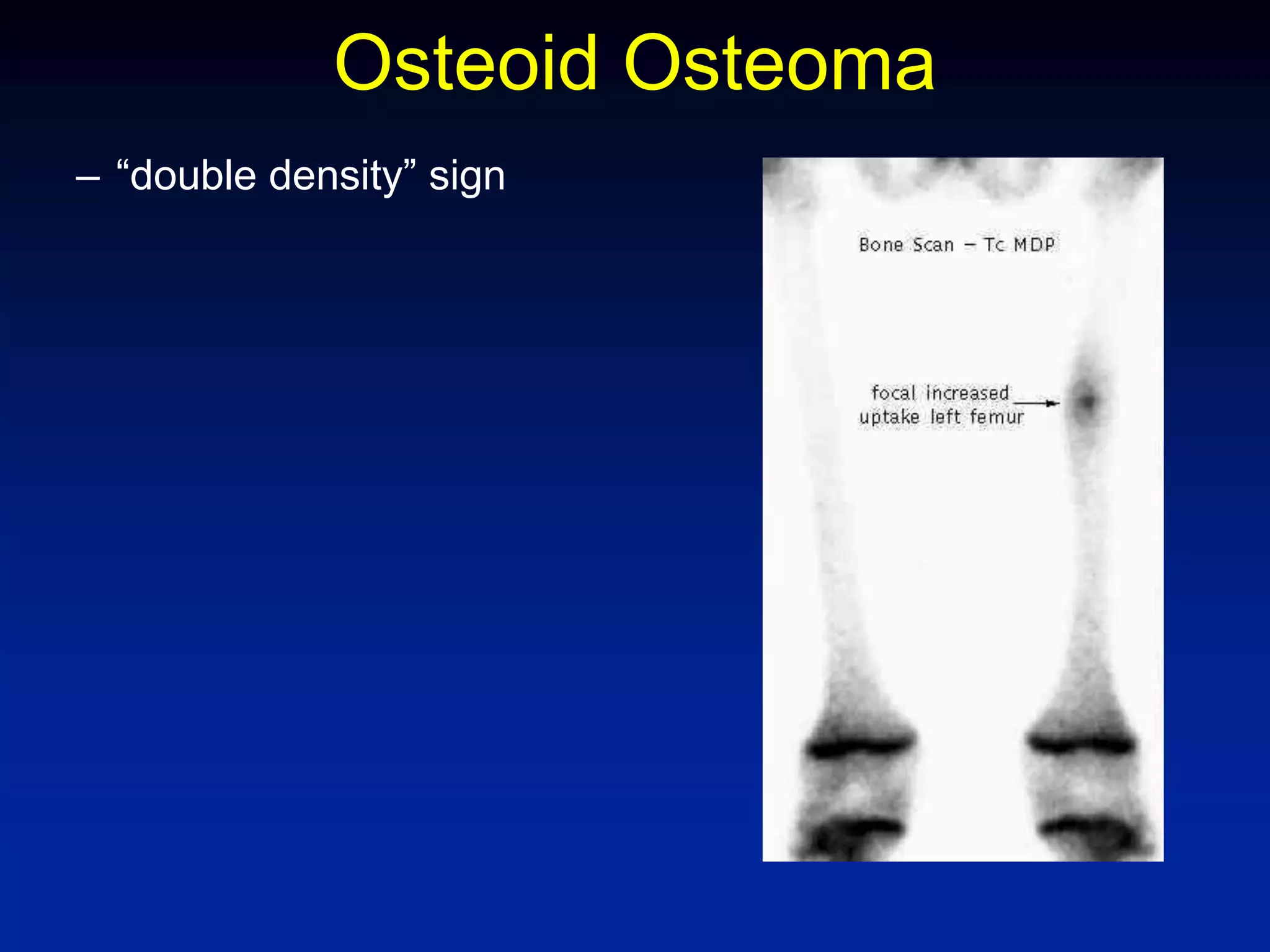 Osteoid Osteoma
– “double density” sign
 