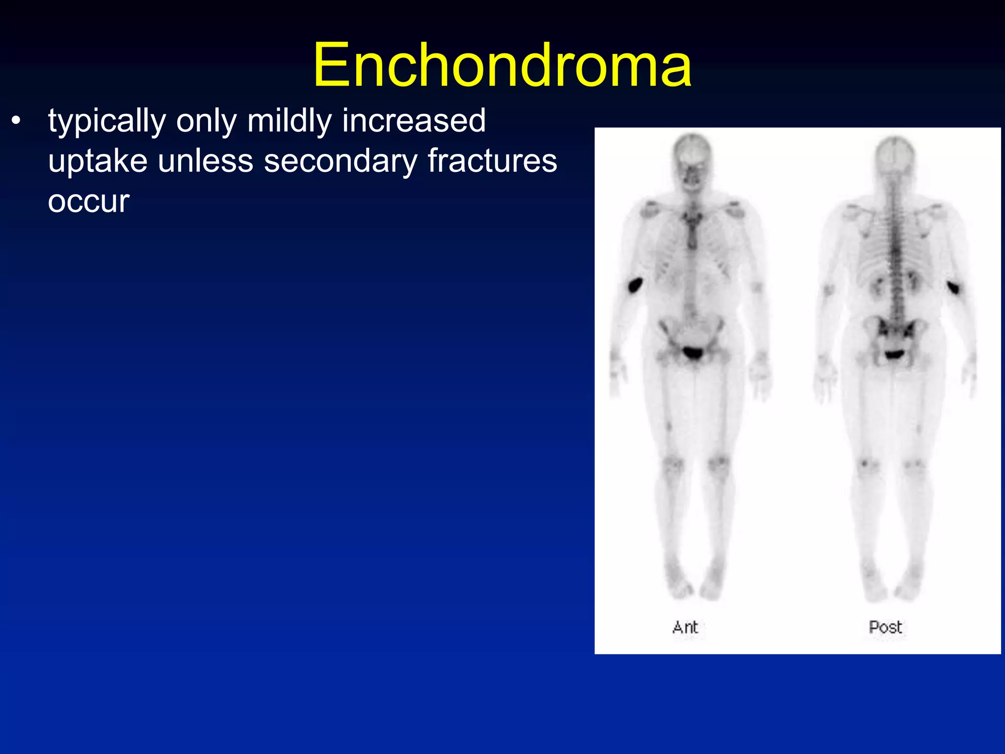 Enchondroma
• typically only mildly increased
uptake unless secondary fractures
occur
 