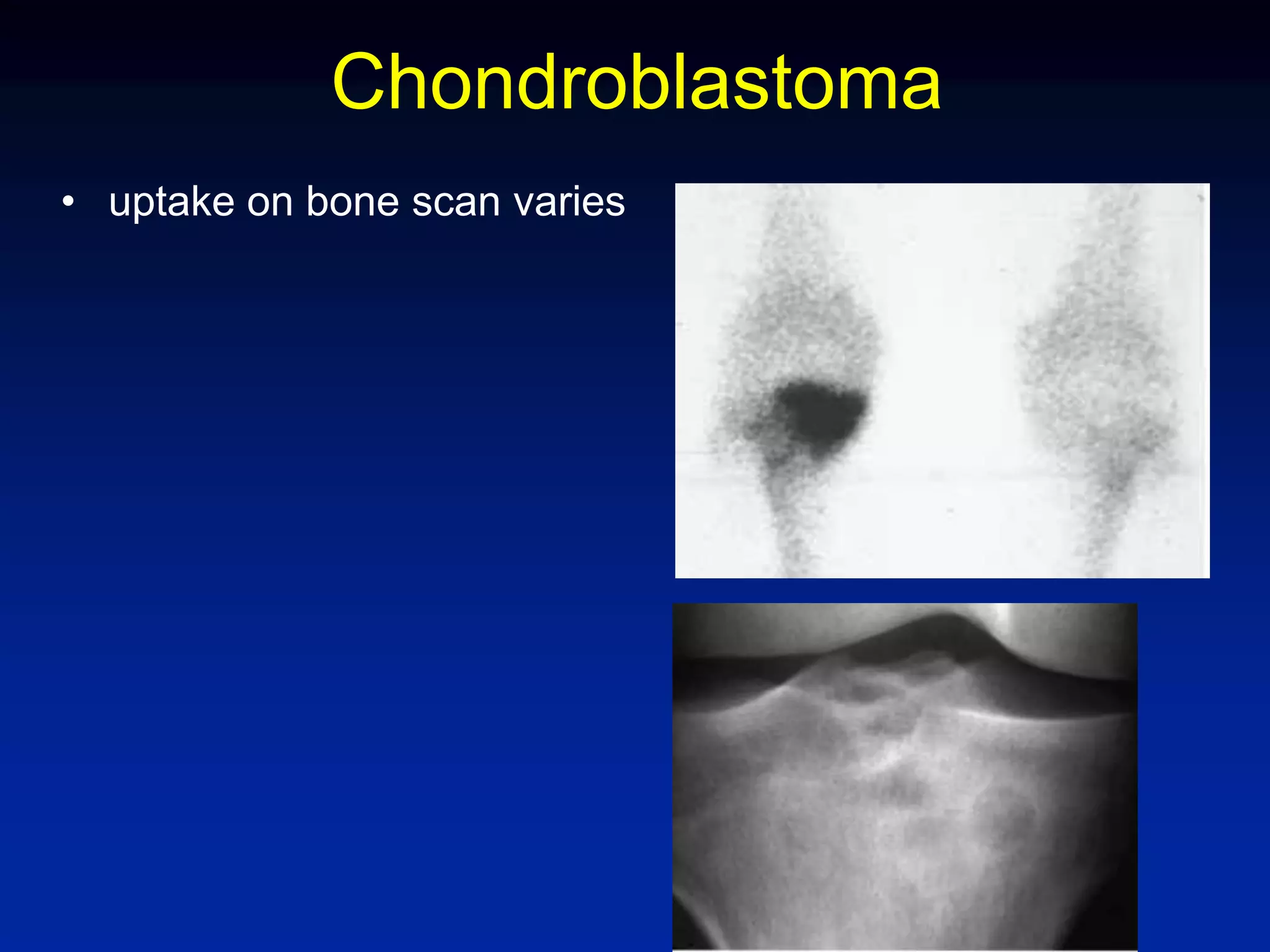 Chondroblastoma
• uptake on bone scan varies
 