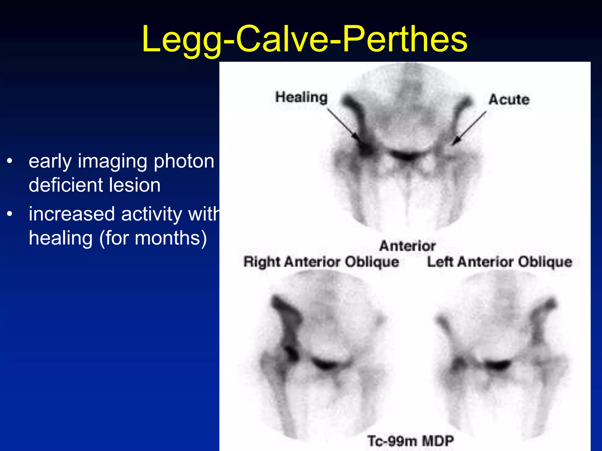 Legg-Calve-Perthes
• early imaging photon
deficient lesion
• increased activity with
healing (for months)
 