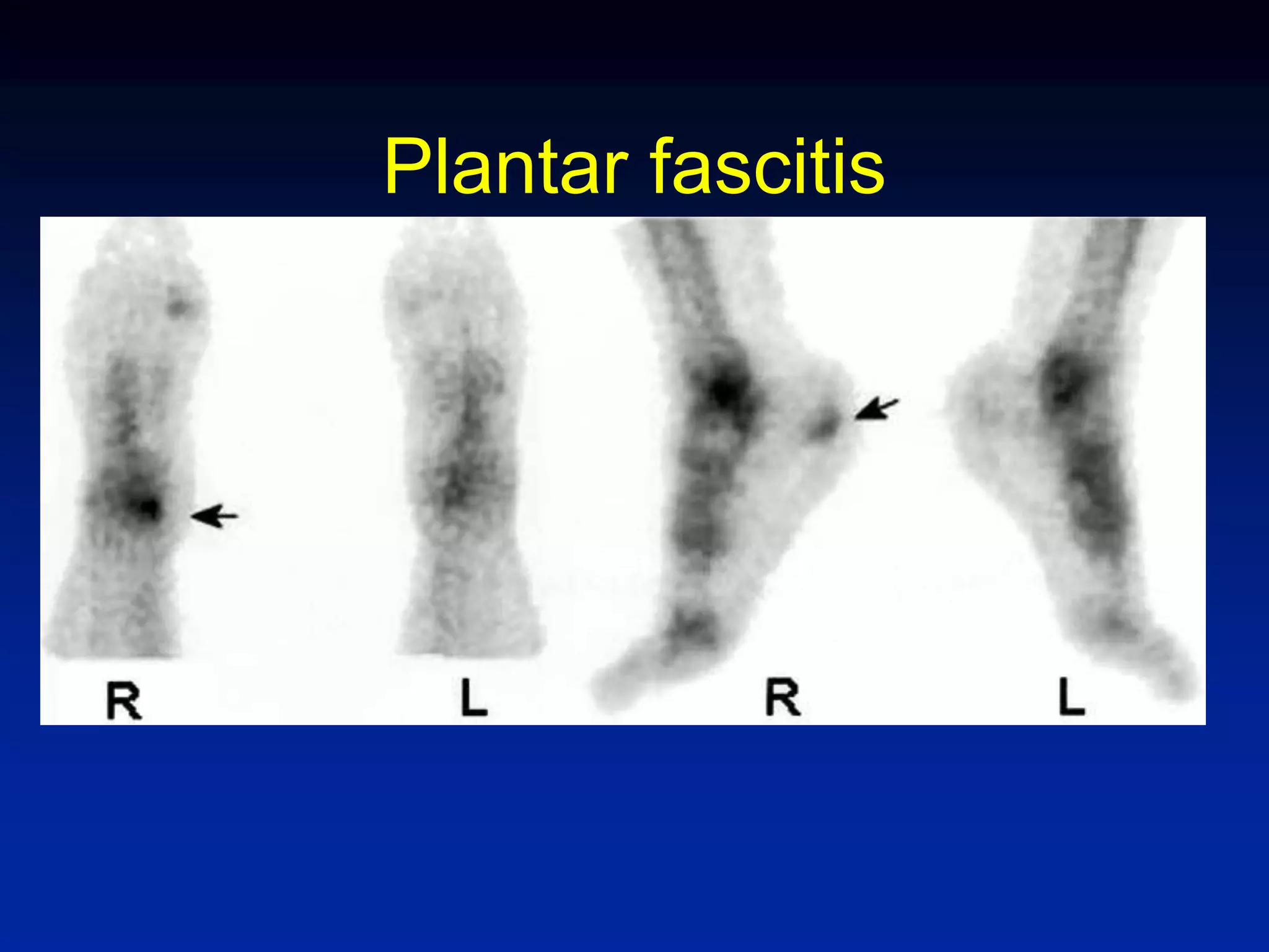 Plantar fascitis
 