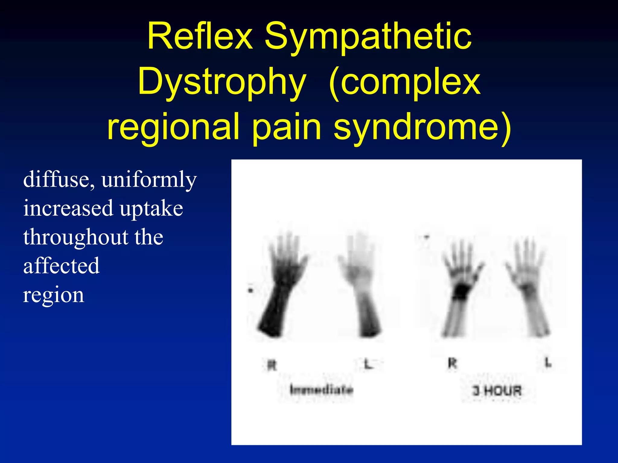 Reflex Sympathetic
Dystrophy (complex
regional pain syndrome)
diffuse, uniformly
increased uptake
throughout the
affected
region
 