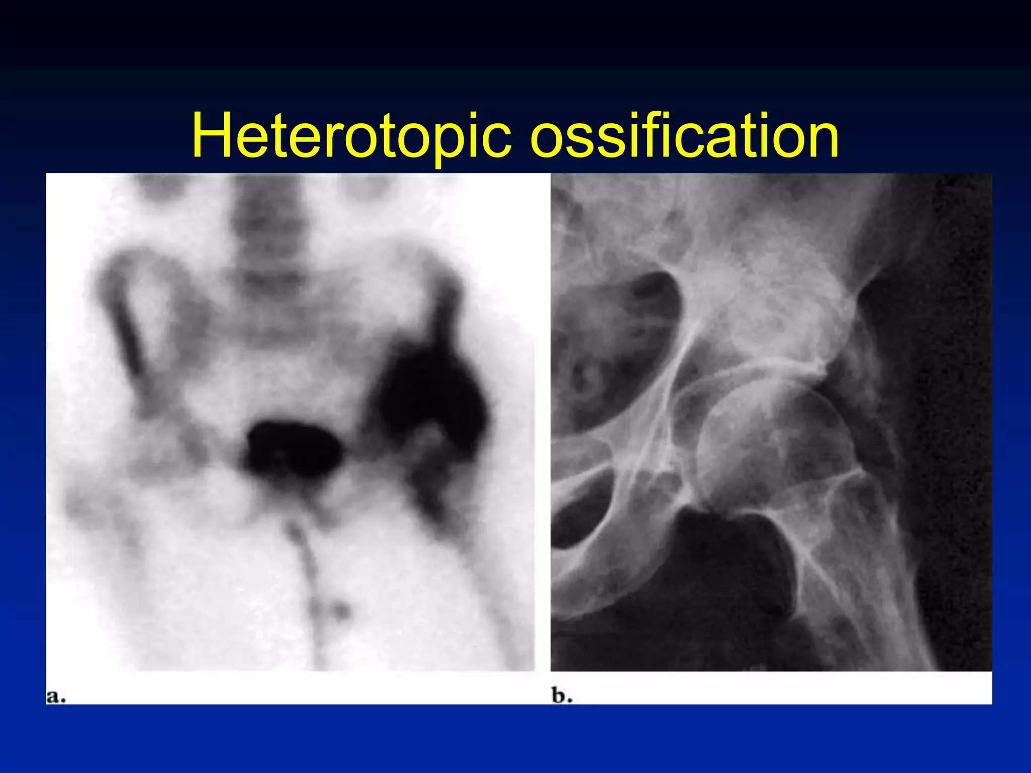 Heterotopic ossification
 