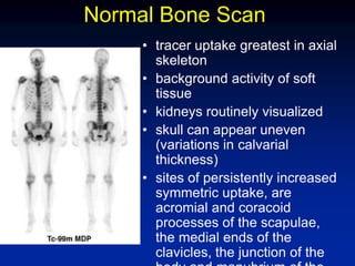 Normal Bone Scan
• tracer uptake greatest in axial
skeleton
• background activity of soft
tissue
• kidneys routinely visualized
• skull can appear uneven
(variations in calvarial
thickness)
• sites of persistently increased
symmetric uptake, are
acromial and coracoid
processes of the scapulae,
the medial ends of the
clavicles, the junction of the
 