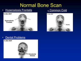 Normal Bone Scan
• Hyperostosis Frontalis
• Dental Problems
Common Cold
 