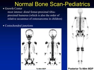 Normal Bone Scan-Pediatrics
Growth Center
most intense: distal femur-proximal tibia-
proximal humerus (which is also the order of
relative occurence of osteosarcoma in children)
Costochondral junctions
 