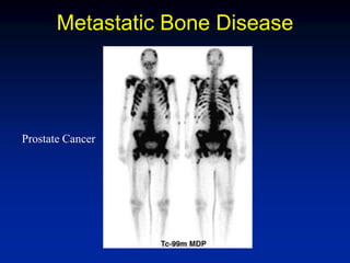Metastatic Bone Disease
Prostate Cancer
 