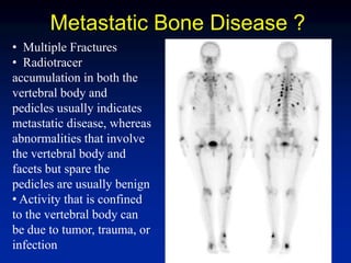Metastatic Bone Disease ?
• Multiple Fractures
• Radiotracer
accumulation in both the
vertebral body and
pedicles usually indicates
metastatic disease, whereas
abnormalities that involve
the vertebral body and
facets but spare the
pedicles are usually benign
• Activity that is confined
to the vertebral body can
be due to tumor, trauma, or
infection
 
