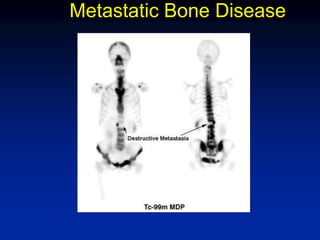 Metastatic Bone Disease
 