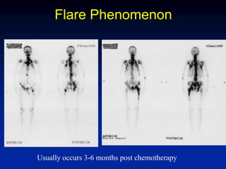 Flare Phenomenon
Usually occurs 3-6 months post chemotherapy
 