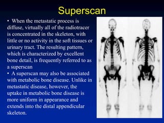 Superscan
• When the metastatic process is
diffuse, virtually all of the radiotracer
is concentrated in the skeleton, with
little or no activity in the soft tissues or
urinary tract. The resulting pattern,
which is characterized by excellent
bone detail, is frequently referred to as
a superscan
• A superscan may also be associated
with metabolic bone disease. Unlike in
metastatic disease, however, the
uptake in metabolic bone disease is
more uniform in appearance and
extends into the distal appendicular
skeleton.
 