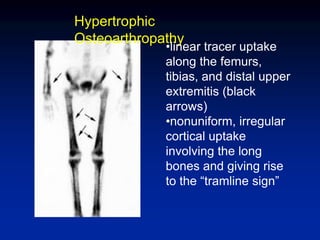 Hypertrophic
Osteoarthropathy
•linear tracer uptake
along the femurs,
tibias, and distal upper
extremitis (black
arrows)
•nonuniform, irregular
cortical uptake
involving the long
bones and giving rise
to the “tramline sign”
 