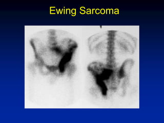 Ewing Sarcoma
 