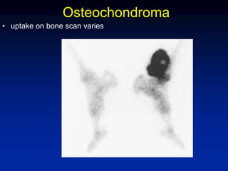 Osteochondroma
• uptake on bone scan varies
 