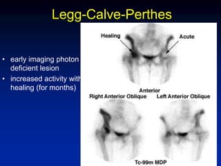 Legg-Calve-Perthes
• early imaging photon
deficient lesion
• increased activity with
healing (for months)
 