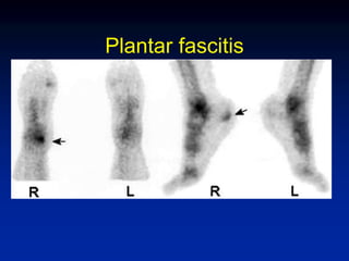 Plantar fascitis
 