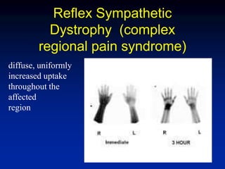 Reflex Sympathetic
Dystrophy (complex
regional pain syndrome)
diffuse, uniformly
increased uptake
throughout the
affected
region
 