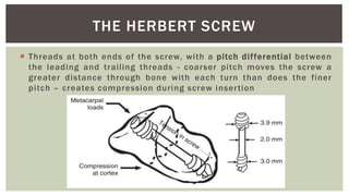 Differential Threads Bone screws - Principles and biomechanics - Dr. Sachin M | PPTX