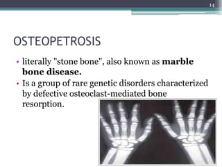 OSTEOPETROSIS
• literally "stone bone", also known as marble
bone disease.
• Is a group of rare genetic disorders characterized
by defective osteoclast-mediated bone
resorption.
14
 