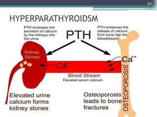 HYPERPARATHYROIDSM
20
 