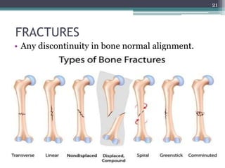 FRACTURES
• Any discontinuity in bone normal alignment.
21
 