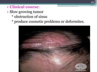 • Clinical course:
• Slow growing tumor
* obstruction of sinus
* produce cosmetic problems or deformites.
29
 