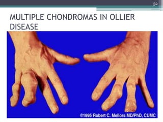 MULTIPLE CHONDROMAS IN OLLIER
DISEASE
52
 
