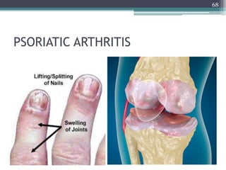 PSORIATIC ARTHRITIS
68
 