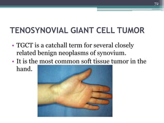 TENOSYNOVIAL GIANT CELL TUMOR
• TGCT is a catchall term for several closely
related benign neoplasms of synovium.
• It is the most common soft tissue tumor in the
hand.
72
 