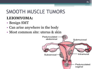 SMOOTH MUSCLE TUMORS
LEIOMYOMA:
• Benign SMT
• Can arise anywhere in the body
• Most common site: uterus & skin
81
 