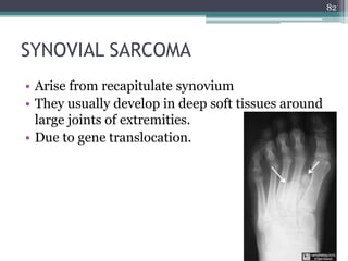 SYNOVIAL SARCOMA
• Arise from recapitulate synovium
• They usually develop in deep soft tissues around
large joints of extremities.
• Due to gene translocation.
82
 