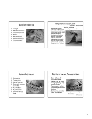 Temporomandibular Joint

Lateral closeup
1.
2.
3.
4.
5.
6.
7.

Condyle
Articular eminence
Coronoid process
Ramus
Articular fossa
Mandibular notch
Coronoid notch

Articular or gleniod fossa
Articular eminance
• Mandibular condyle
articulates with temporal
bone in the articular fossa
(also called glenoid fossa,
mandibular fossa)
• Most anterior border of
articular fossa is the
articular eminance
• If someone opens wide
and the condyle slides
anterior to the eminance,
the person has “lockjaw”

6

7

Lateral closeup
Dehiscence
Fenestration
Mental foramen
Zygomatic process
of maxilla
5. Alveolar bone
6. Alveolar crest
7. External oblique
ridge

Dehiscence vs Fenestration

1.
2.
3.
4.

7

• Bony defects of
unknown cause
• Neither can be found
radiographically, only
during surgery
• Fenestration, defect
completely surrounded
by bone
• Dehiscence, alveolar
crest bone absent
fenestration

dehiscence

4

 