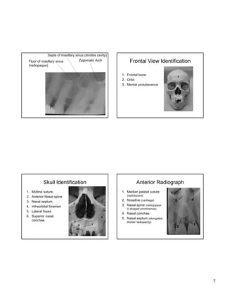 Septa of maxillary sinus (divides cavity)
Zygomatic Arch

Floor of maxillary sinus
(radiopaque)

Frontal View Identification
1. Frontal bone
2. Orbit
3. Mental protuberance

Skull Identification
1.
2.
3.
4.
5.
6.

Midline suture
Anterior Nasal spine
Nasal septum
Infraorbital foramen
Lateral fossa
Superior nasal
conchae

Anterior Radiograph
1. Median palatal suture

5

(radiolucent)
6

2. Noseline (cartilage)
3. Nasal spine (radiopaque
V-shaped prominence)

4. Nasal conchae
5. Nasal septum (elongated,
thicker radiopacity)

7

 