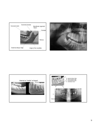 Coronoid process
Coronoid notch

Mandibular (sigmoid)
Notch
Condyle

External oblique ridge
(thicker radiopaque band)

Ramus

External oblique ridge

Angle of the mandible

Note: External/internal ridges often “superimposed” over each other radiographically;
therefore difficult to differentiate between the two; external always superior to internal
oblique ridge (mylohyoid muscle attachment); internal usually runs below roots of mandibular
molars (see figure 26-62 Haring)

ABCD-

Internal on “inside” or lingual

external oblique ridge
internal oblique ridge
submandibular fossa
mandibular canal

A

B

Hyoid bone

9

 