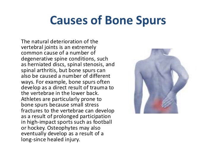 What to Expect from a Bone Spur in Your Back