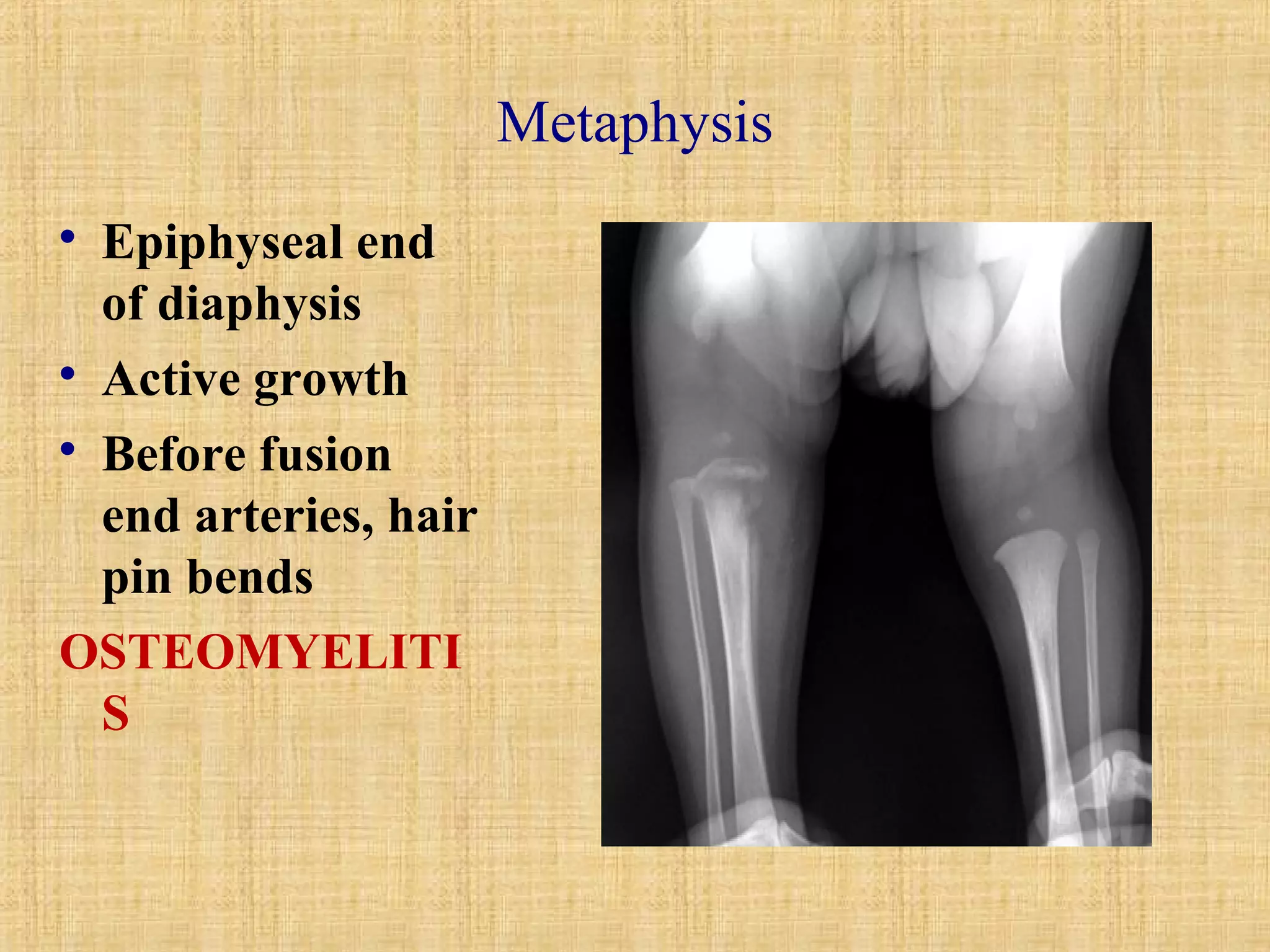Metaphysis 
 Epiphyseal end 
of diaphysis 
 Active growth 
 Before fusion 
end arteries, hair 
pin bends 
OSTEOMYELITI 
S 
 