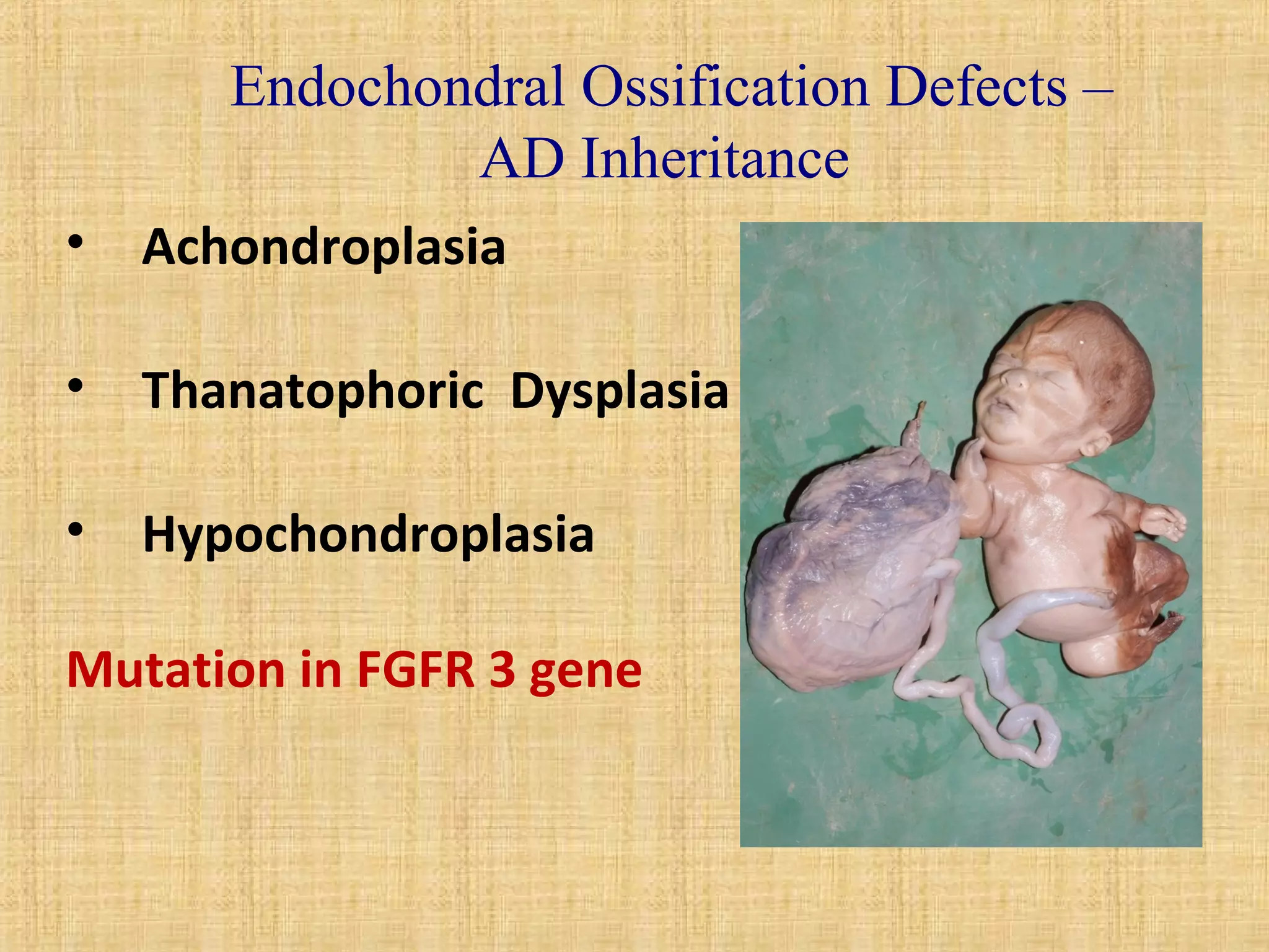 Endochondral Ossification Defects – 
AD Inheritance 
• Achondroplasia 
• Thanatophoric Dysplasia 
• Hypochondroplasia 
Mutation in FGFR 3 gene 
 