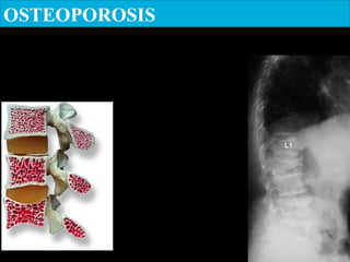 OSTEOPOROSIS
What happens in our body
especially after menopause?
 
