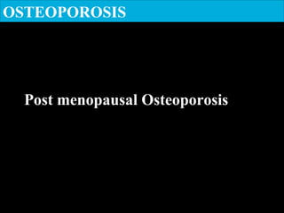 OSTEOPOROSIS
Post menopausal Osteoporosis
 