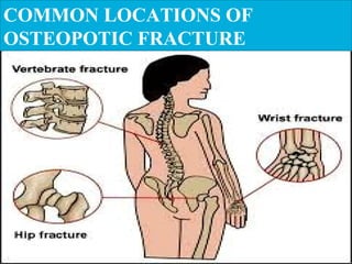 COMMON LOCATIONS OF
OSTEOPOTIC FRACTURE
 